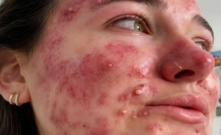 Dormir con maquillaje: qué puede pasarle realmente a tu piel y cómo evitar brotes de acné