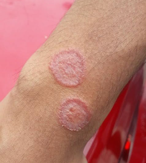 Infecciones por hongos en las piernas: causas reales y cuidados que sí ayudan